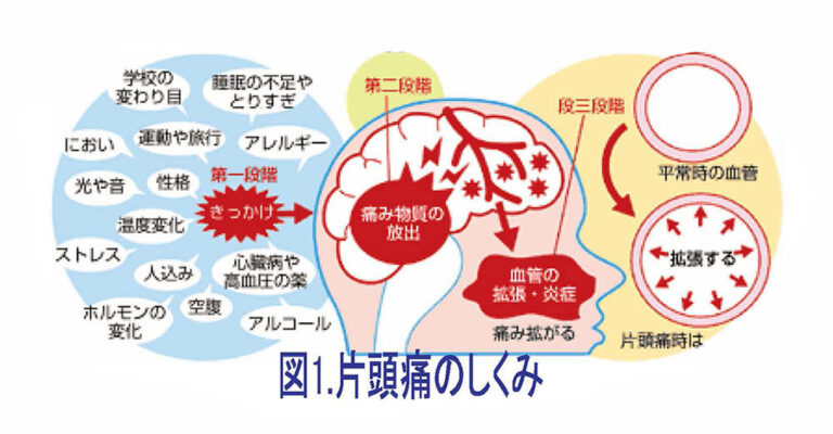 錯乱性片頭痛とは何ですか?